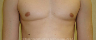 Врождённая асимметрия груди