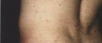 Могут ли эти пятна быть проявлением сифилиса?