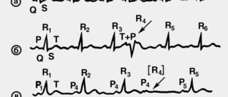 Экстрасистолия. Панические атаки