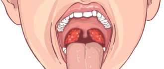 Частые ангины