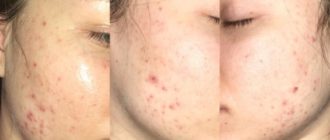 Возвращение акне после отмены Сотрета