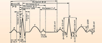 ЭКГ- требуется расшифровка