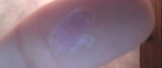 Мозоли на пенисе