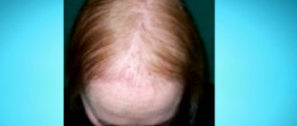 Выпадают волосы, киста в груди, прыщи, не могу набрать вес