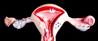 Мелоксикам при аденомикоза и очень обильных месячных