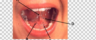 Воспалился подъязычный сосок и железа