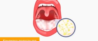 Длительный фарингит, кандидоз в полости рта