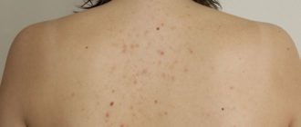 Черные точки на спине