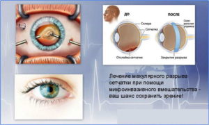 Можно ли заниматся спортом при повреждёной сетчатке?