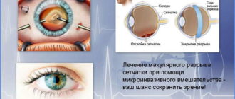 Можно ли заниматся спортом при повреждёной сетчатке?