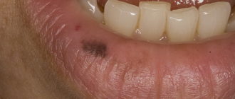 Черная точка на губе