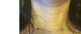 Давление после операции удаления щитовидки