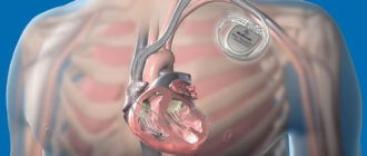 Что делать. Кардиостимулятор остановился