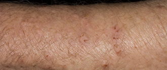 Узловая почесуха