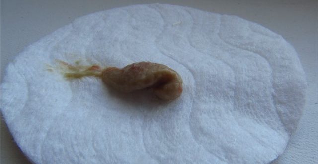 Выделения на 6 неделе