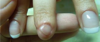 Надо ли срывать ногтевую пластину у ребенка