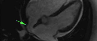 Мрт после дмпп