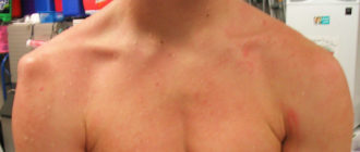 Выскакивает плечо