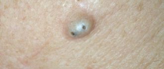 Второй сосок после прыщика