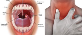 Что то мешает в горле слева
