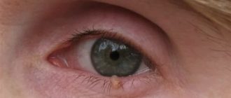 Нарост в углу глаза