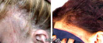 Чем обработать чтобы не было шрама и волосы расли?