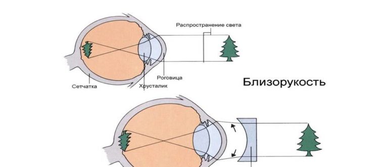 Со скольки можно делать лазерную коррекцию зрения. Удлинение глазного яблока при близорукости. Миопия стационарная операция. Стационарная миопия это. Склеротерапия глаз близорукость.