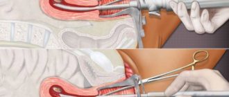 Чистка после фармацевтического аборта