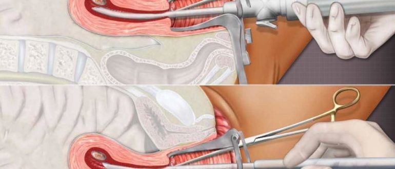 Чистка после фармацевтического аборта
