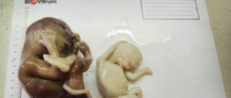 Что нужно делать после выкидыша