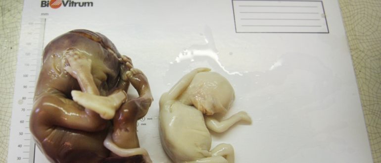 Что нужно делать после выкидыша