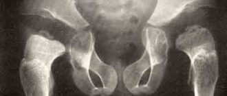 Эпифизарная дисплазия