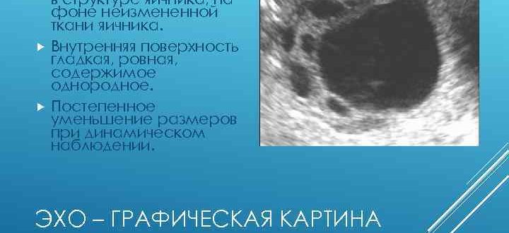 Мелкокистозная структура правого яичника