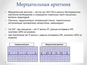 Мерцательная аритмия не лечится