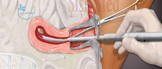 Выделения после рдв