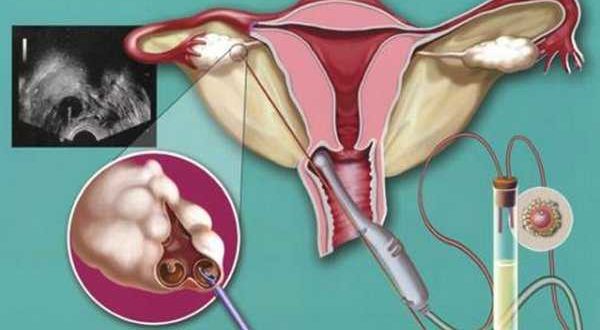 Выбор ОК при Кисте яичника