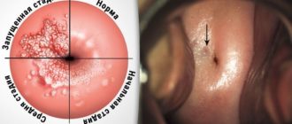 Эндометриоз и ноги