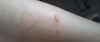 Волдырь чешется, потом водяной пузырик, похожие на укусы насекомого?