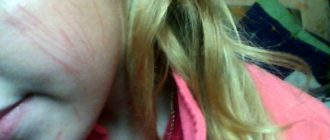 Долго не проходит след от царапины на щеке