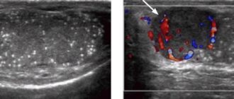 Микрокальцинаты и варикоцеле