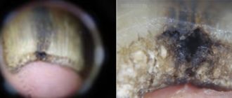 Чем лечить аспергиллез уха