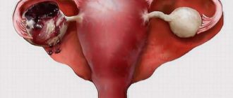 Может ли лопнуть фолликулярная киста, препараты для лечения