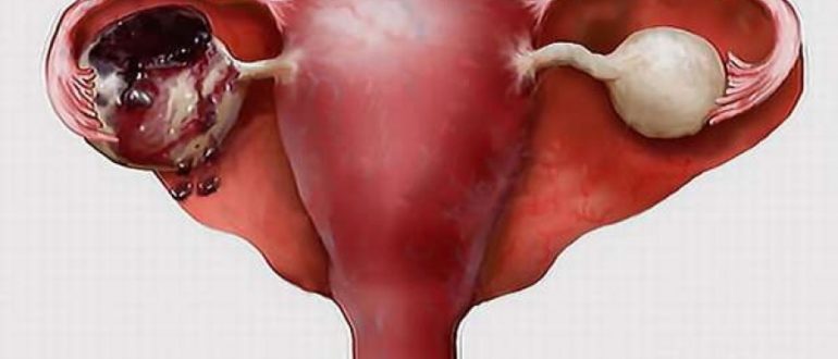 Может ли лопнуть фолликулярная киста, препараты для лечения