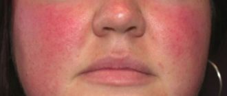 Кожа на лице не краснеет вообще