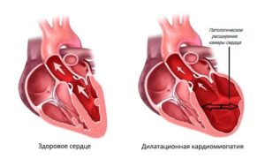 Дилатационная кардиомиопатия, нарушение ритма. Армия