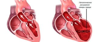 Дилатационная кардиомиопатия, нарушение ритма. Армия