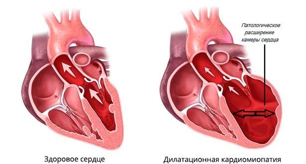 Дилатационная кардиомиопатия, нарушение ритма. Армия