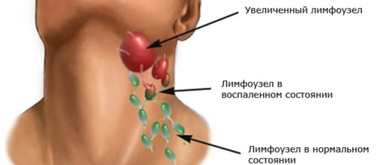 Воспалился и болит лимфоузел на шее