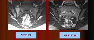 Что такое жировая инфильтрация костного мозга?