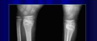 Вколоченный перелом лучевой кости